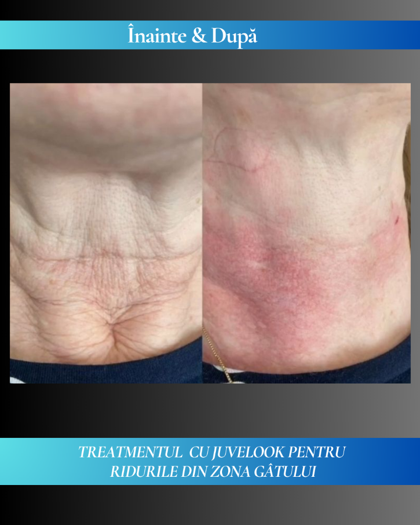 Rezultat clinic JuveLook 8