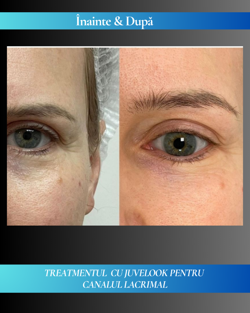 Rezultat clinic JuveLook 10