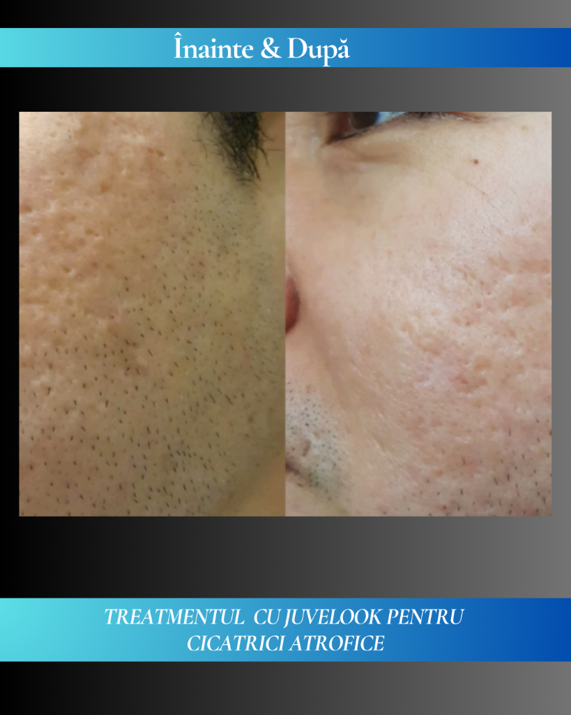 Rezultat clinic JuveLook 4