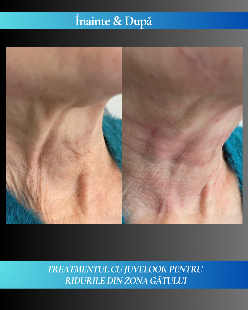 Rezultat clinic JuveLook 7