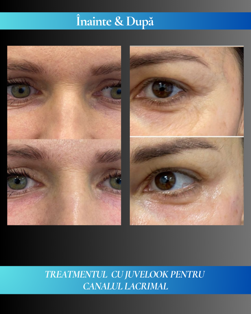 Rezultat clinic JuveLook 5