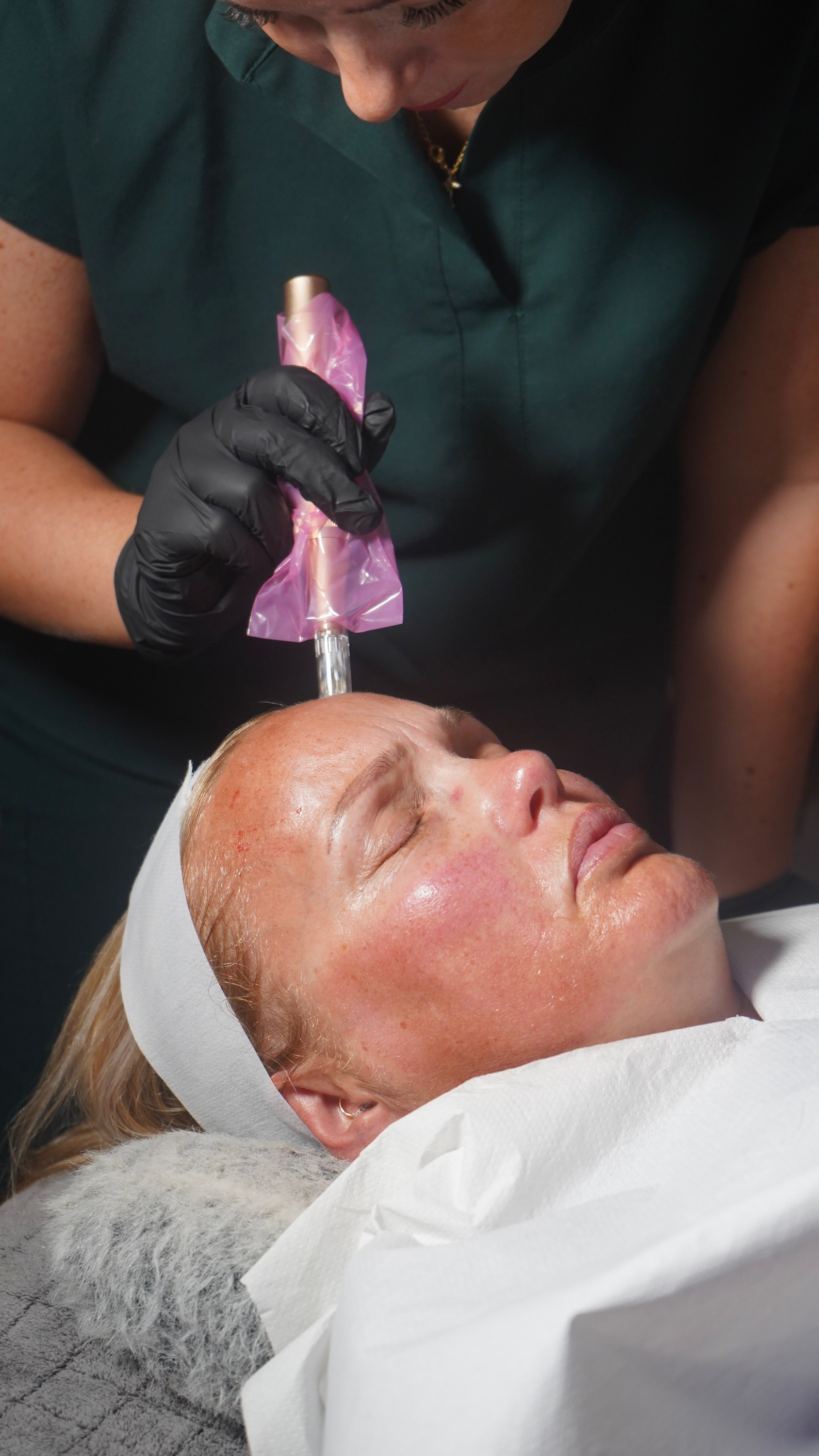 Microneedling and Dermaplaning