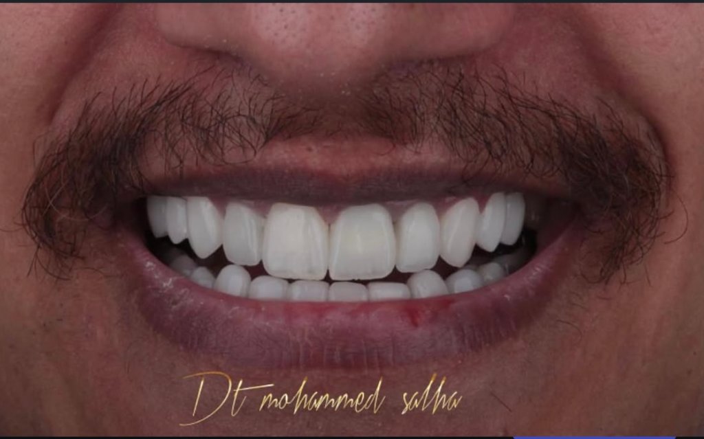 3D Printed Restorations