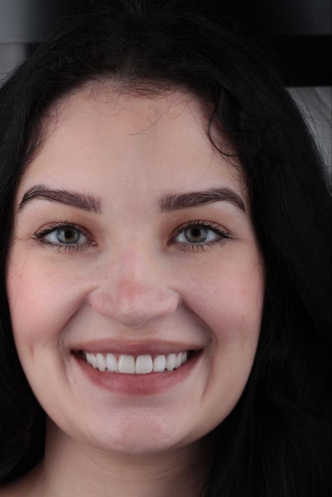 Natural Smile — Close Up