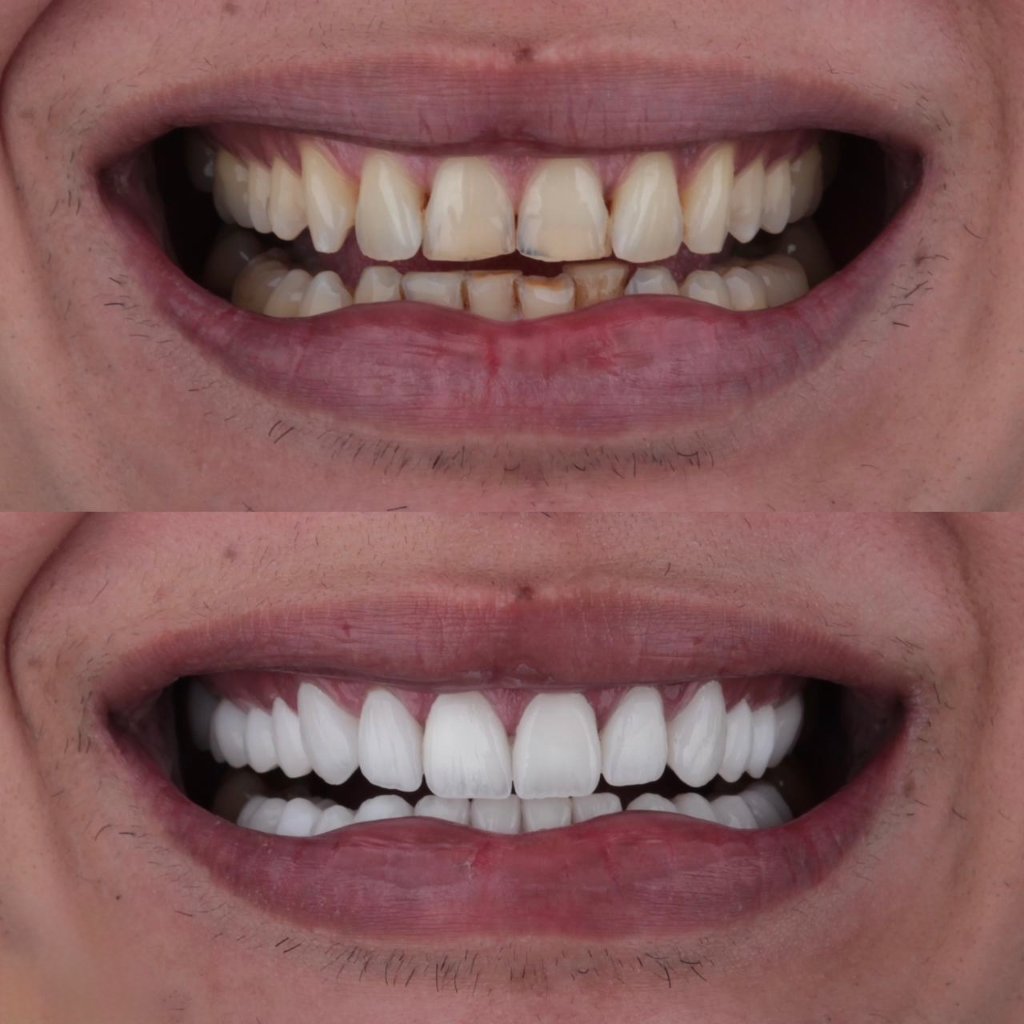 Zirconia Crowns — Lab Detail