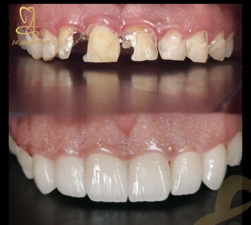 Before & After — Zirconia Crowns