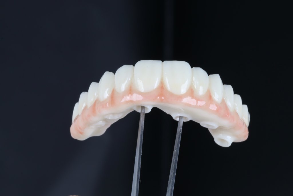 Full Arch Prosthesis