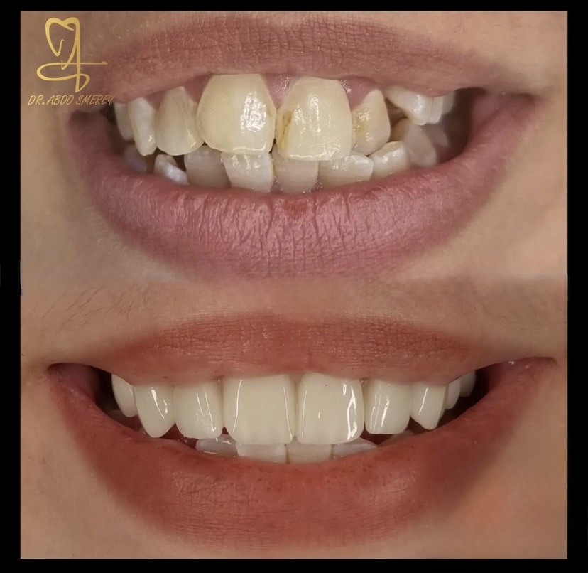 Before & After — Smile Makeover