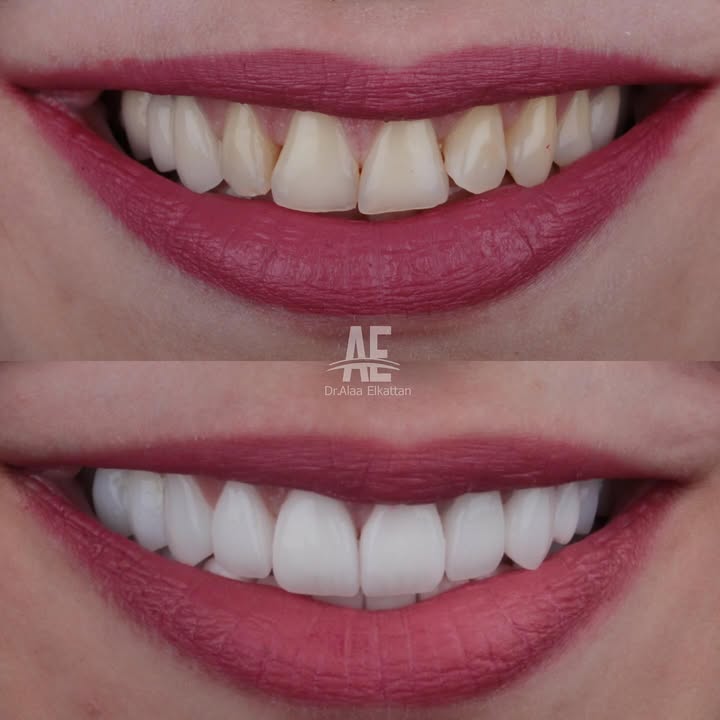 Before & After — Zirconia Full Arch