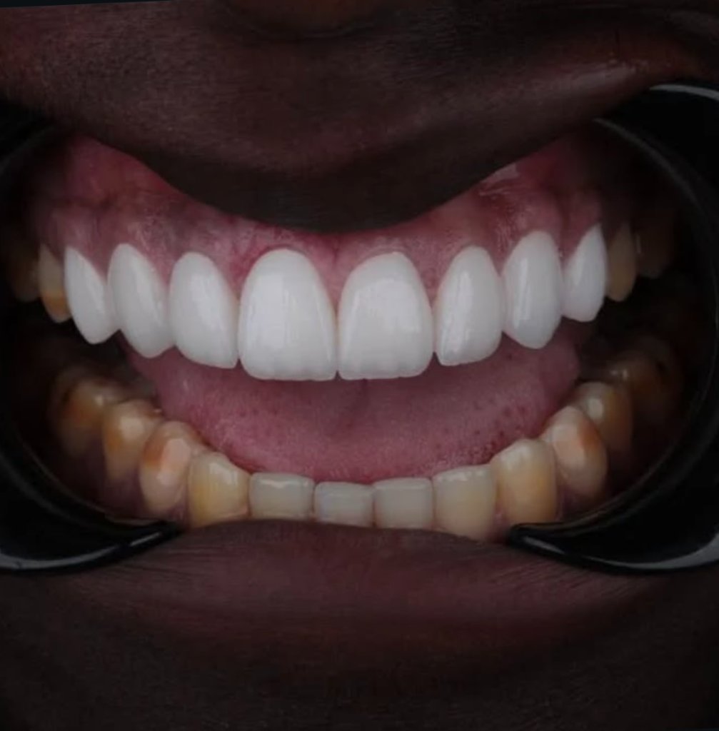 Implant Restorations