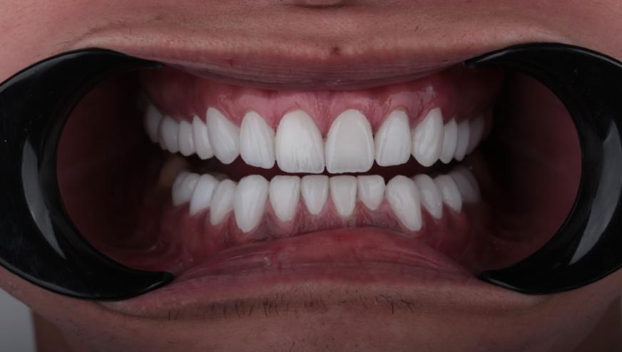 Before & After — Full Smile Makeover