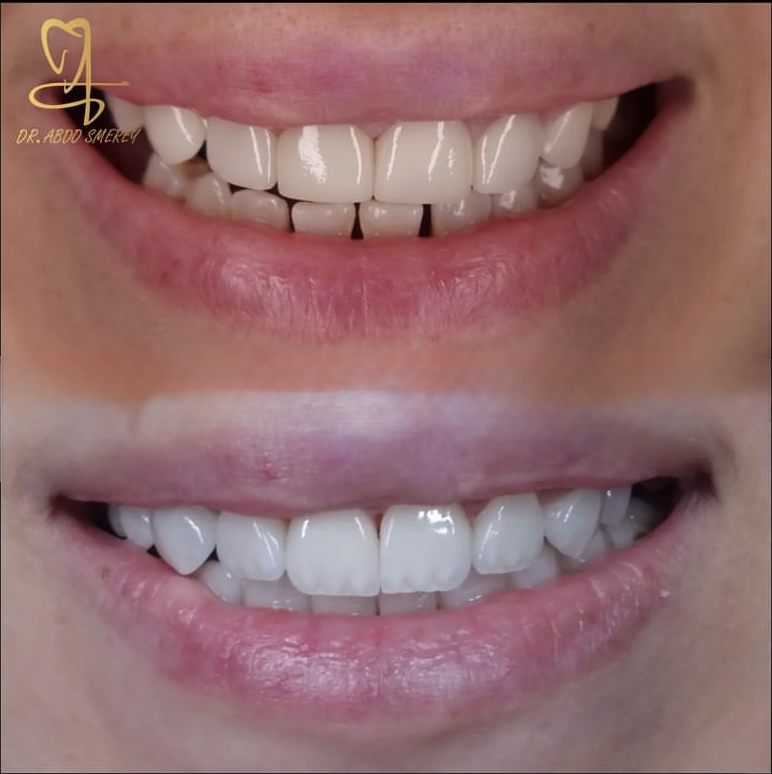 Before & After — Crown Restoration