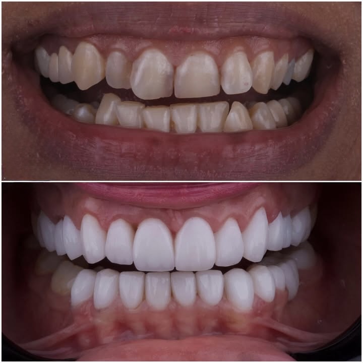 Before & After — Full Smile