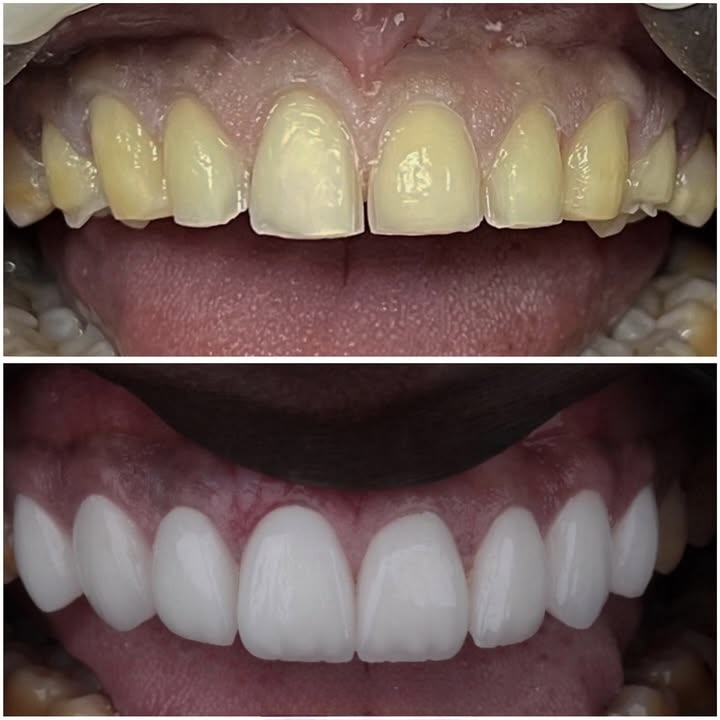 Before & After — Veneer Smile
