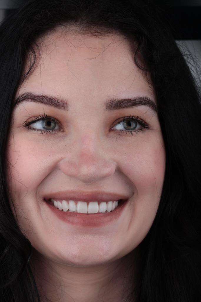 Bright Smile — Veneer Result