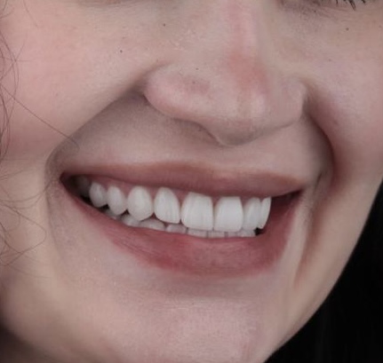 Veneer Smile — Portrait