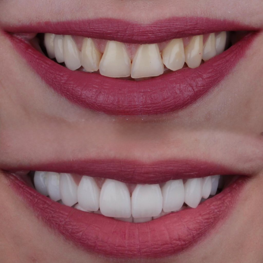Before & After — E.max Veneers