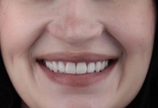 Smile Design Result