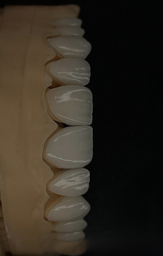 Veneer Set on Model