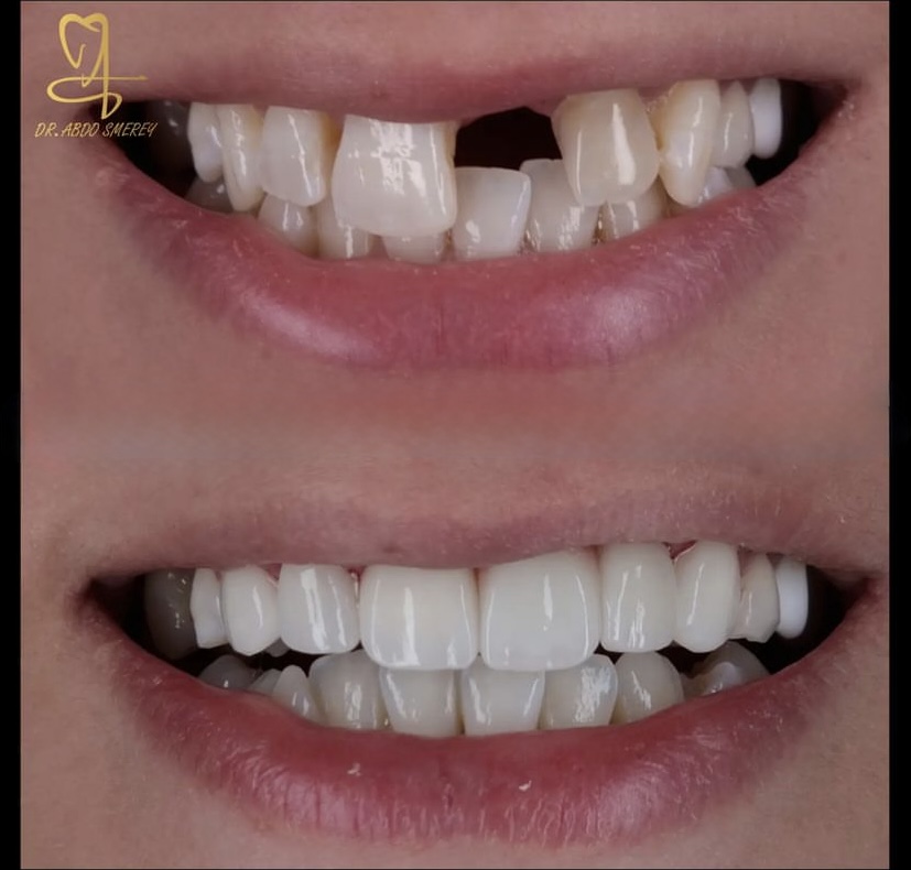 E.max Veneers — Lab Detail