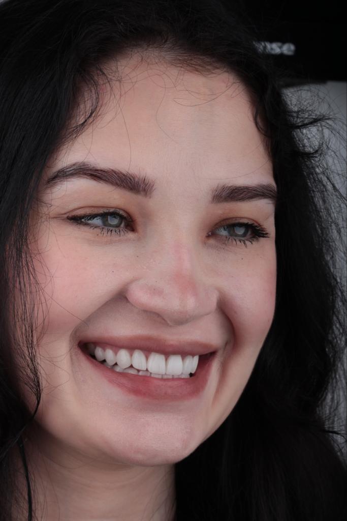 Natural Smile — Full Face