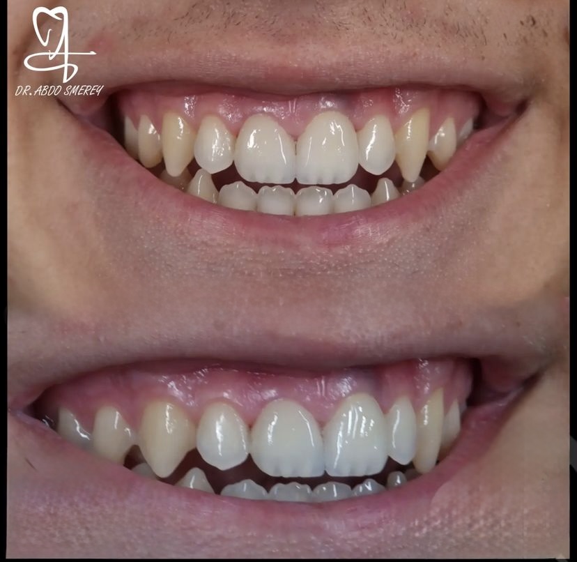 Before & After — Smile Transformation