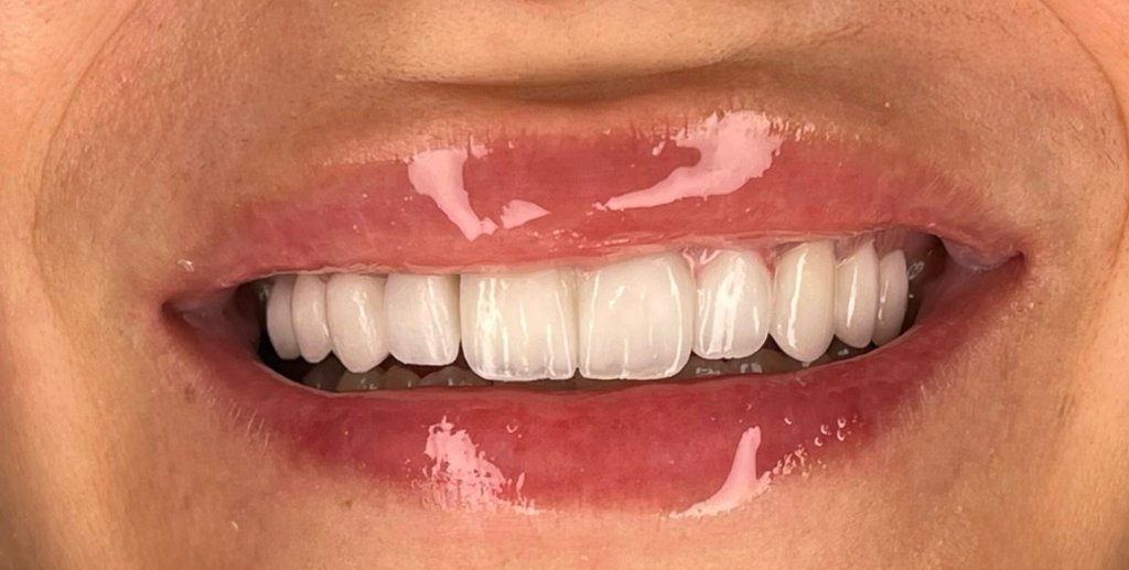 Partial Dentures