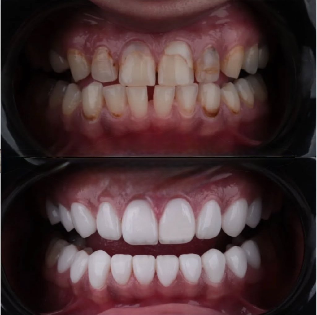 Digital Full Dentures