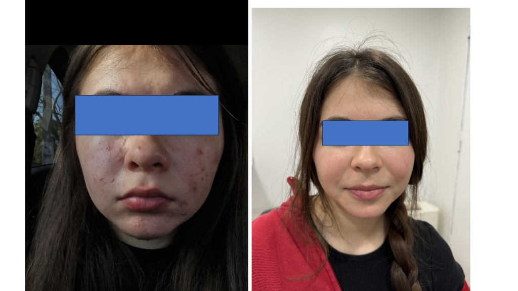 Acné facial severo