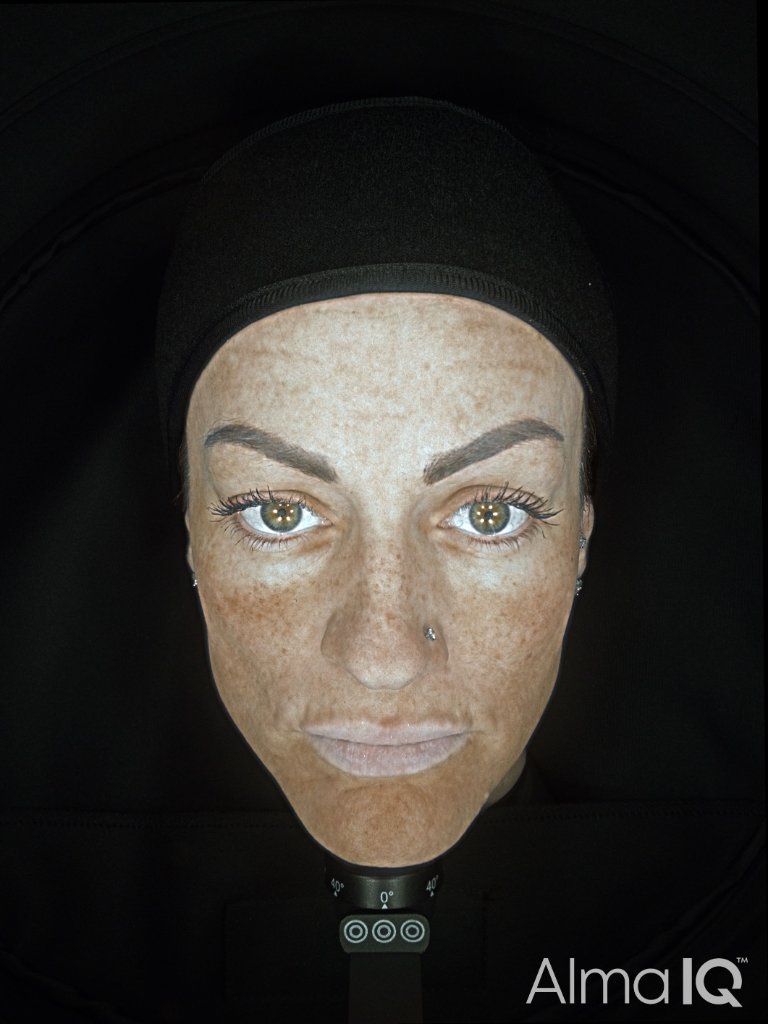 Pigmentation After