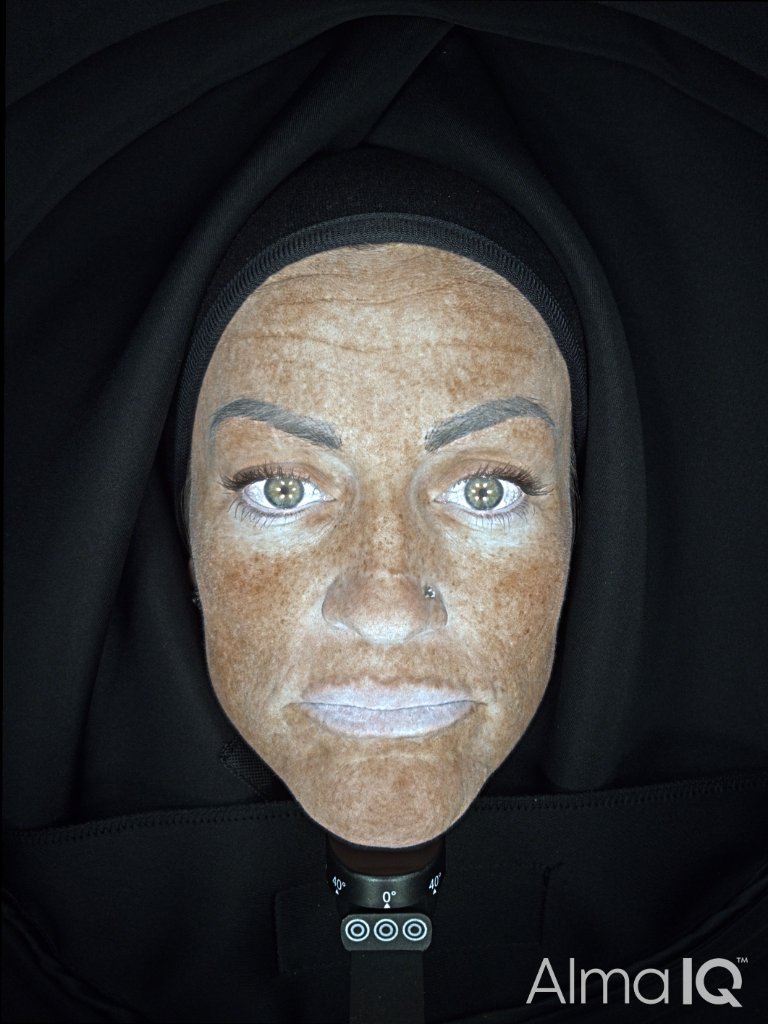 Pigmentation Before