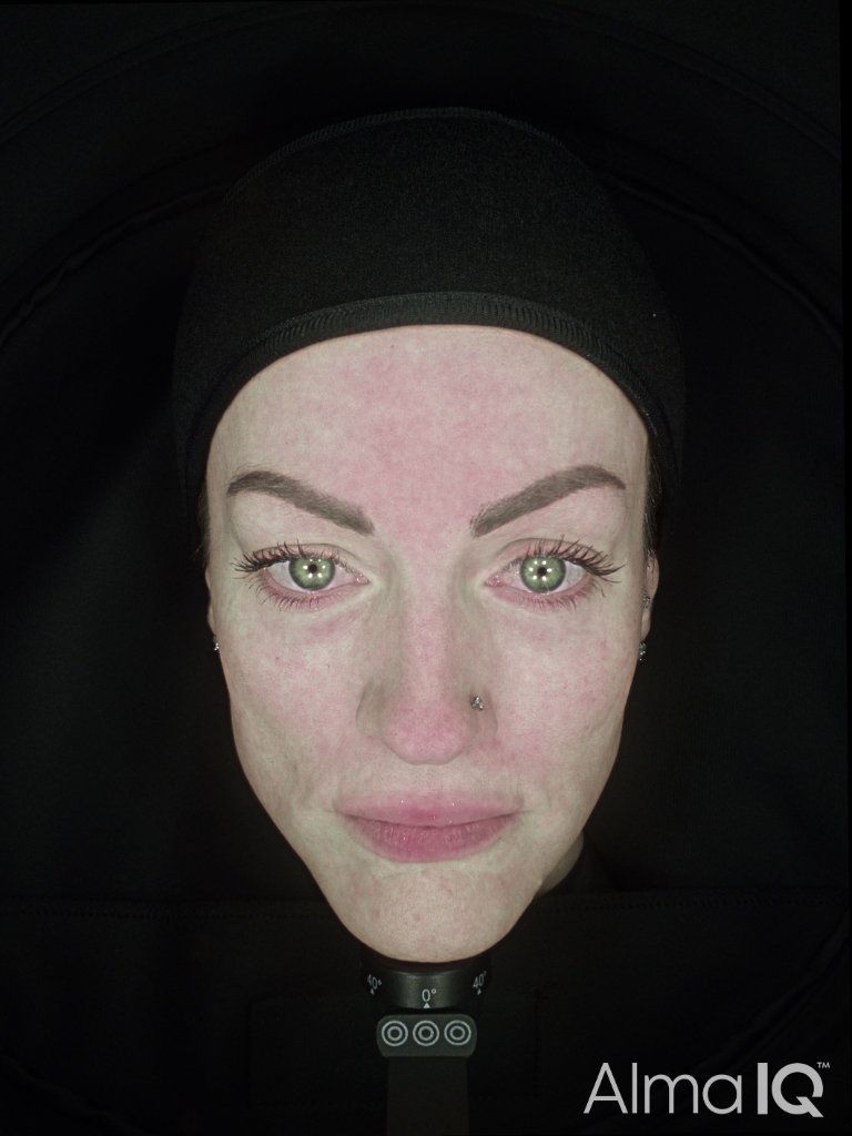 Redness After