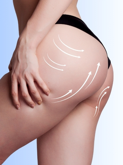 Brazilian Butt Lift (BBL)