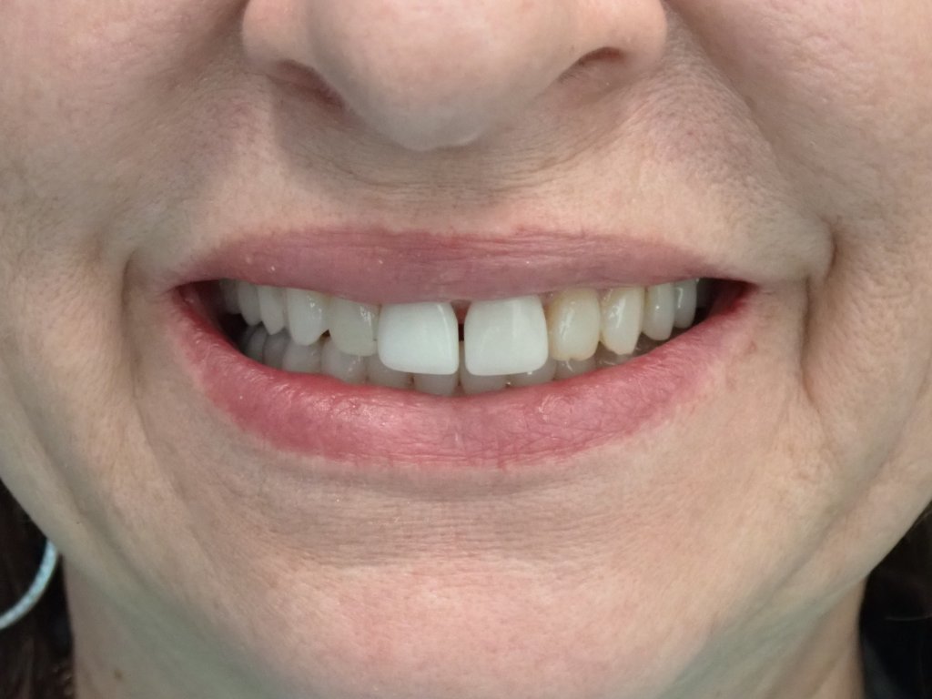 Before - Cosmetic smile makeover before and after — porcelain veneers and crown restorations by Dr. Mohager at Advanced Dentistry & Implants Littleton CO