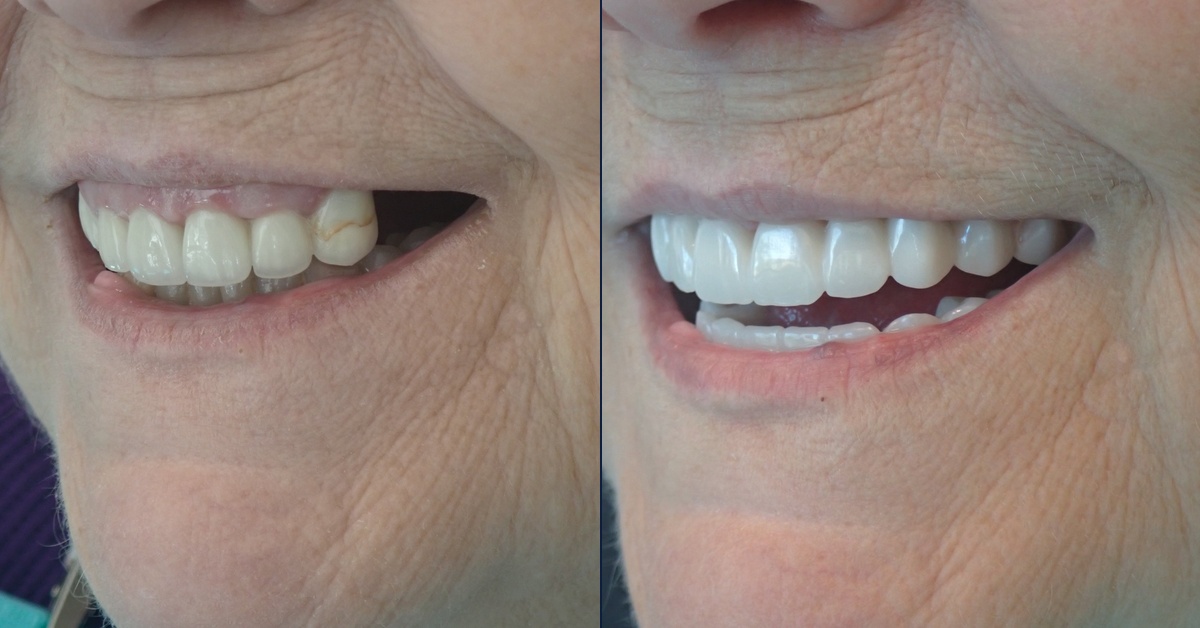 Before and after dental implant case, Dr. Kam Mohager
