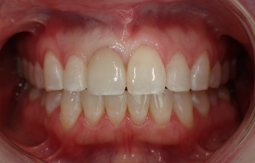 After photo showing restored smile by Dr. Kam Mohager