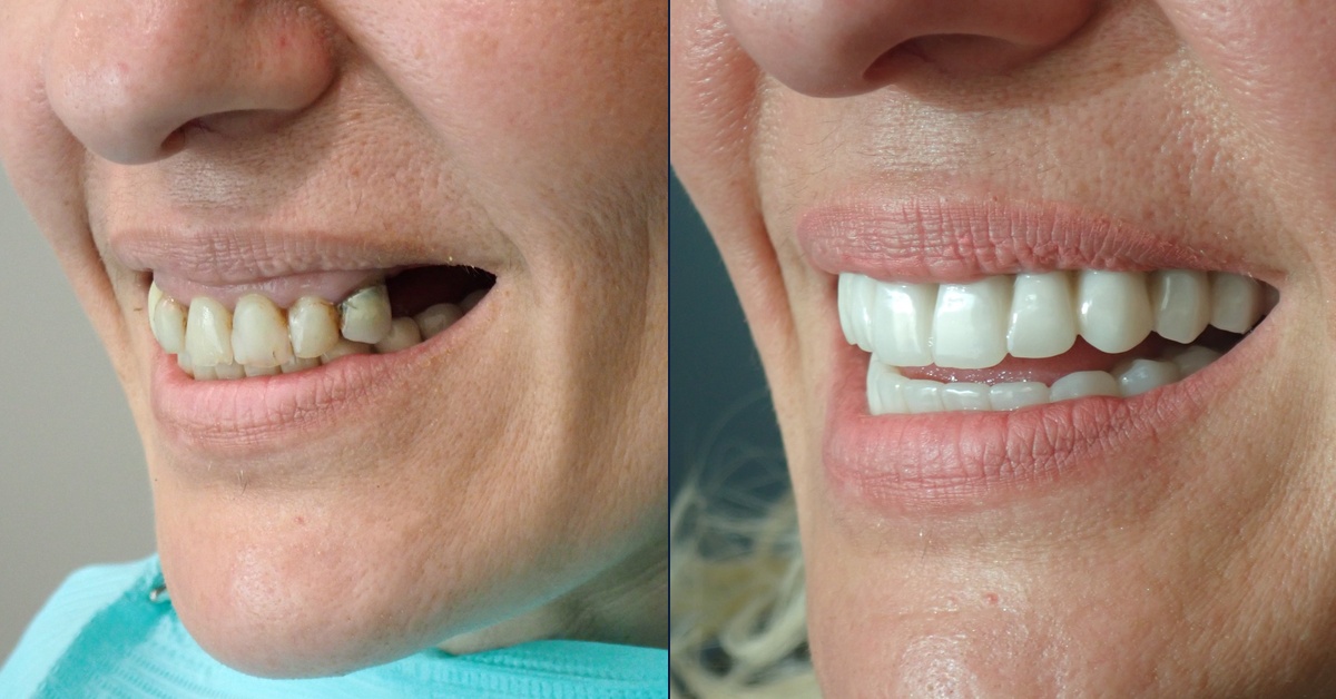 Before and after dental implant case, Dr. Kam Mohager