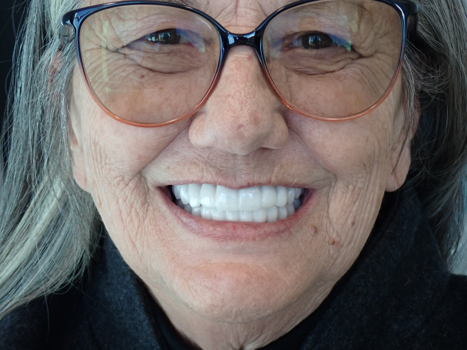 After photo showing restored smile by Dr. Kam Mohager