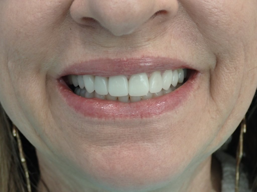 After - Cosmetic smile makeover before and after — porcelain veneers and crown restorations by Dr. Mohager at Advanced Dentistry & Implants Littleton CO