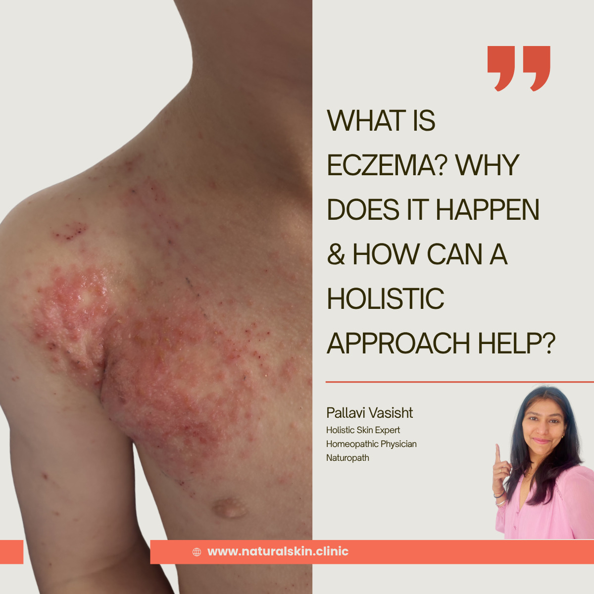 What Is Eczema? Why Does It Happen & How Can a Holistic Approach Help?