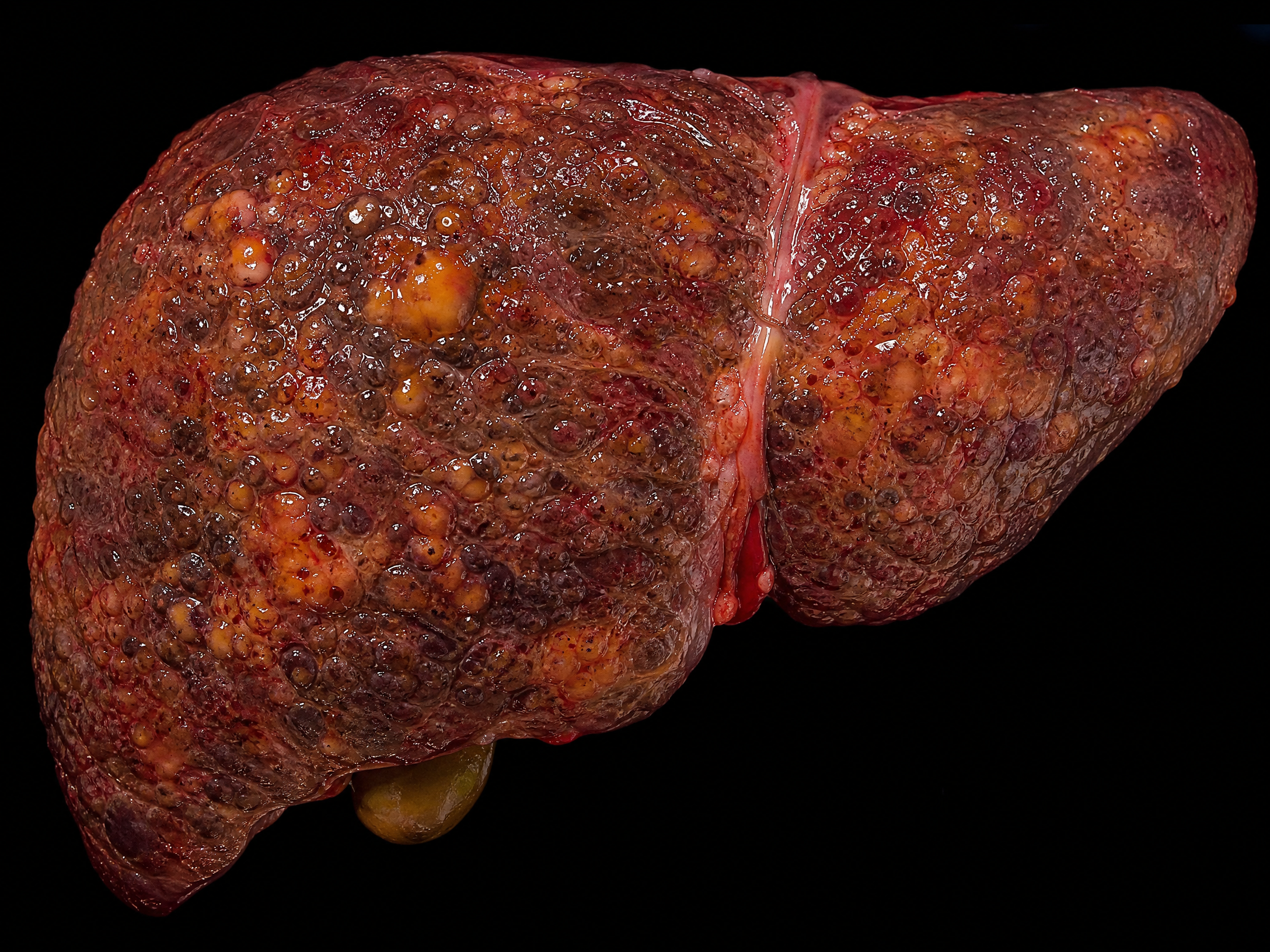 Diseased fatty liver