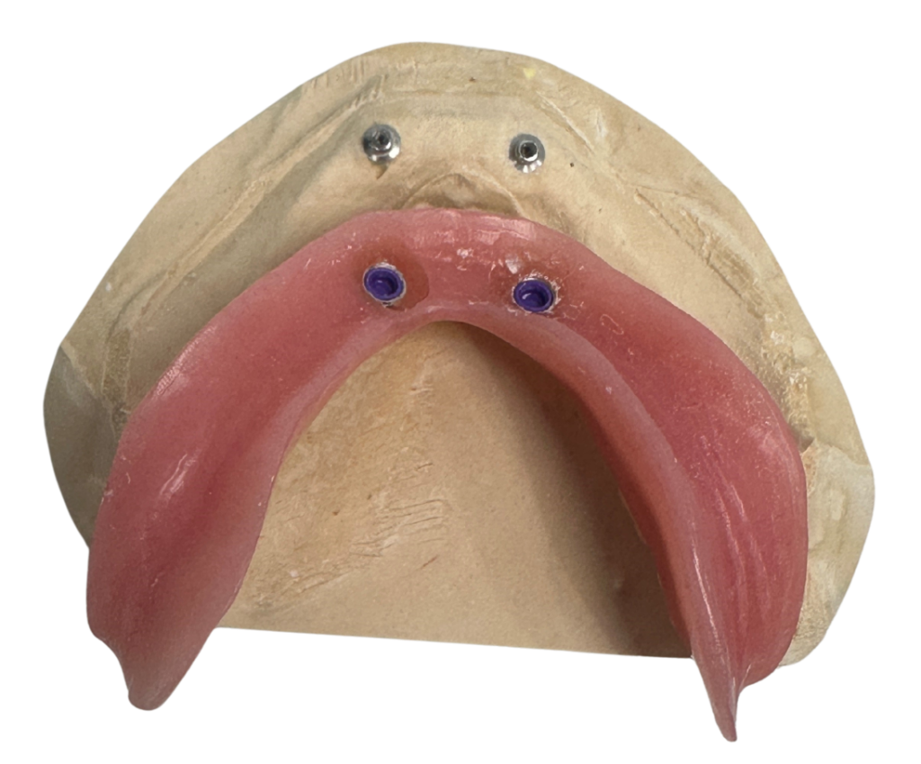Implant-retained denture showing ball attachments on model