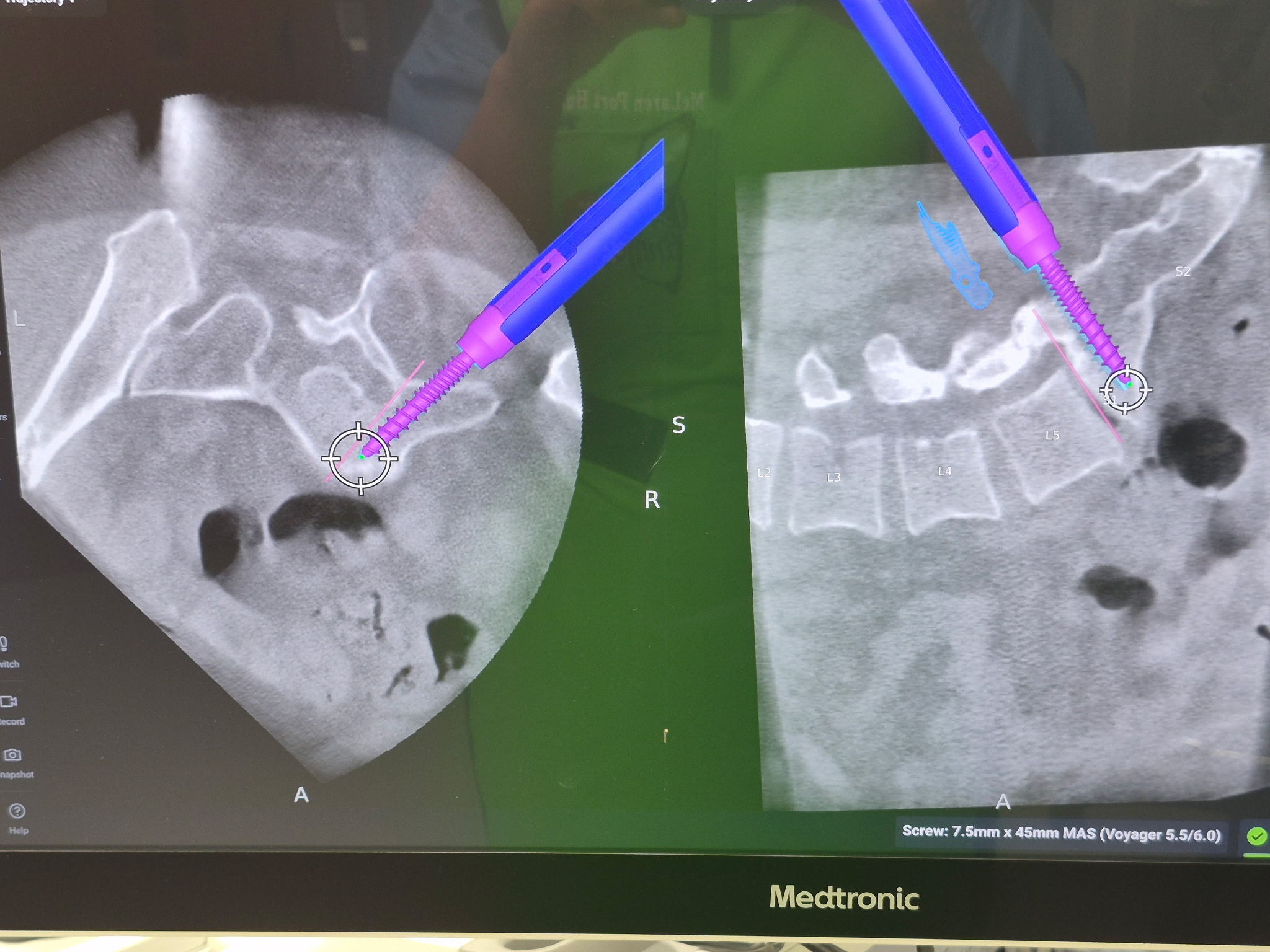 Surgeon at robotic navigation console reviewing 3D spinal imaging