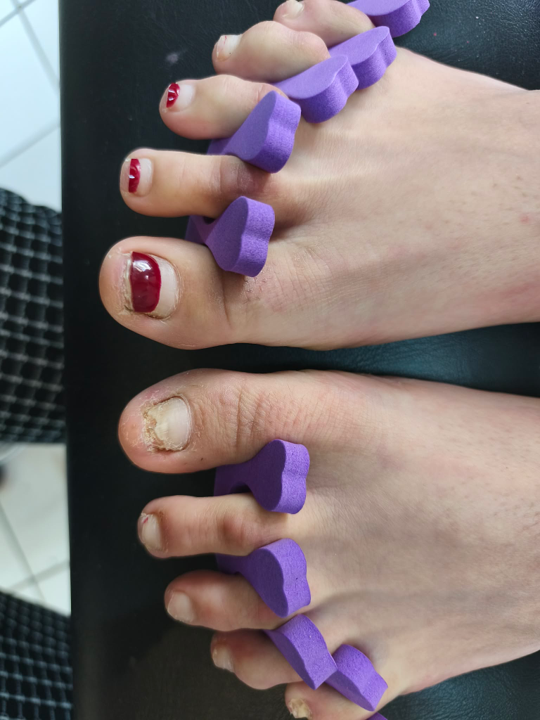 Reconstruction ongles orteils avant après - Lovadia