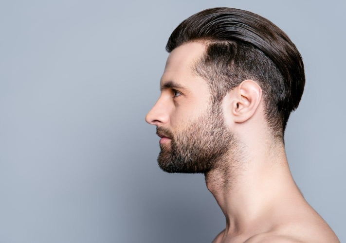 FUE Hair Transplant - Natural Results