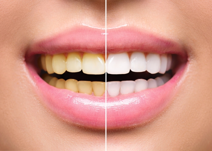 Laser Teeth Whitening