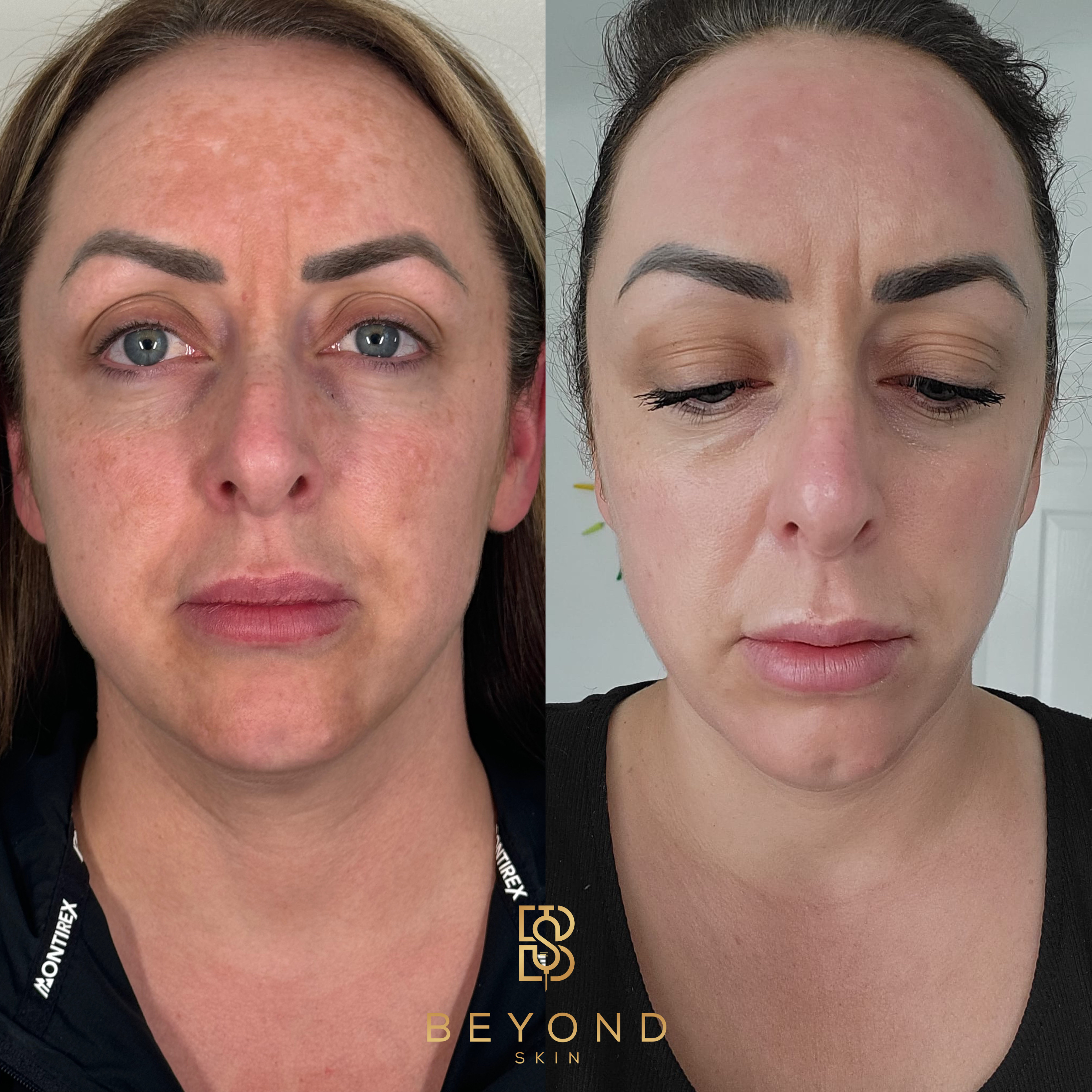 Beyond Skin UK chemical peel before and after — patient one