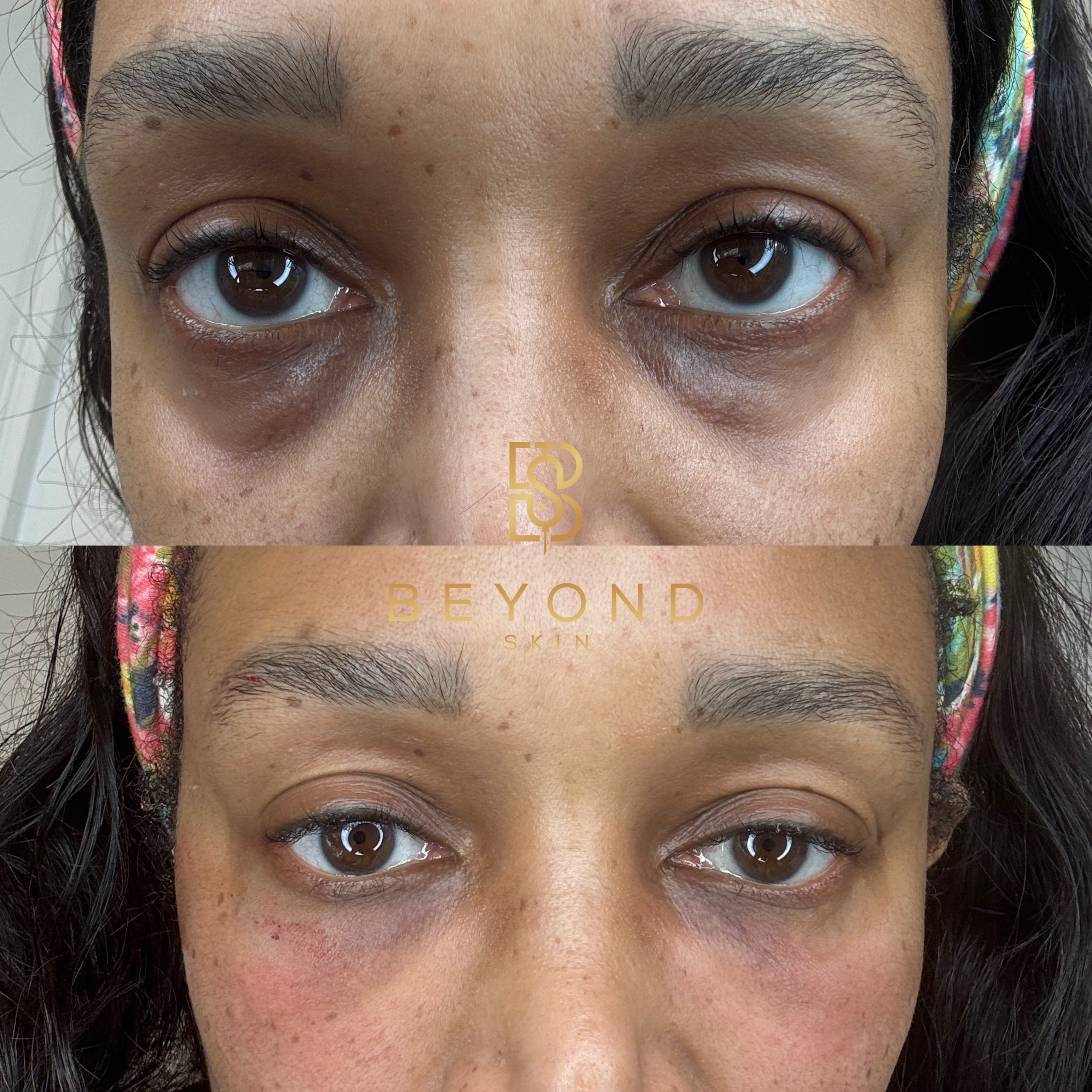 EZ Gel Around the Eye