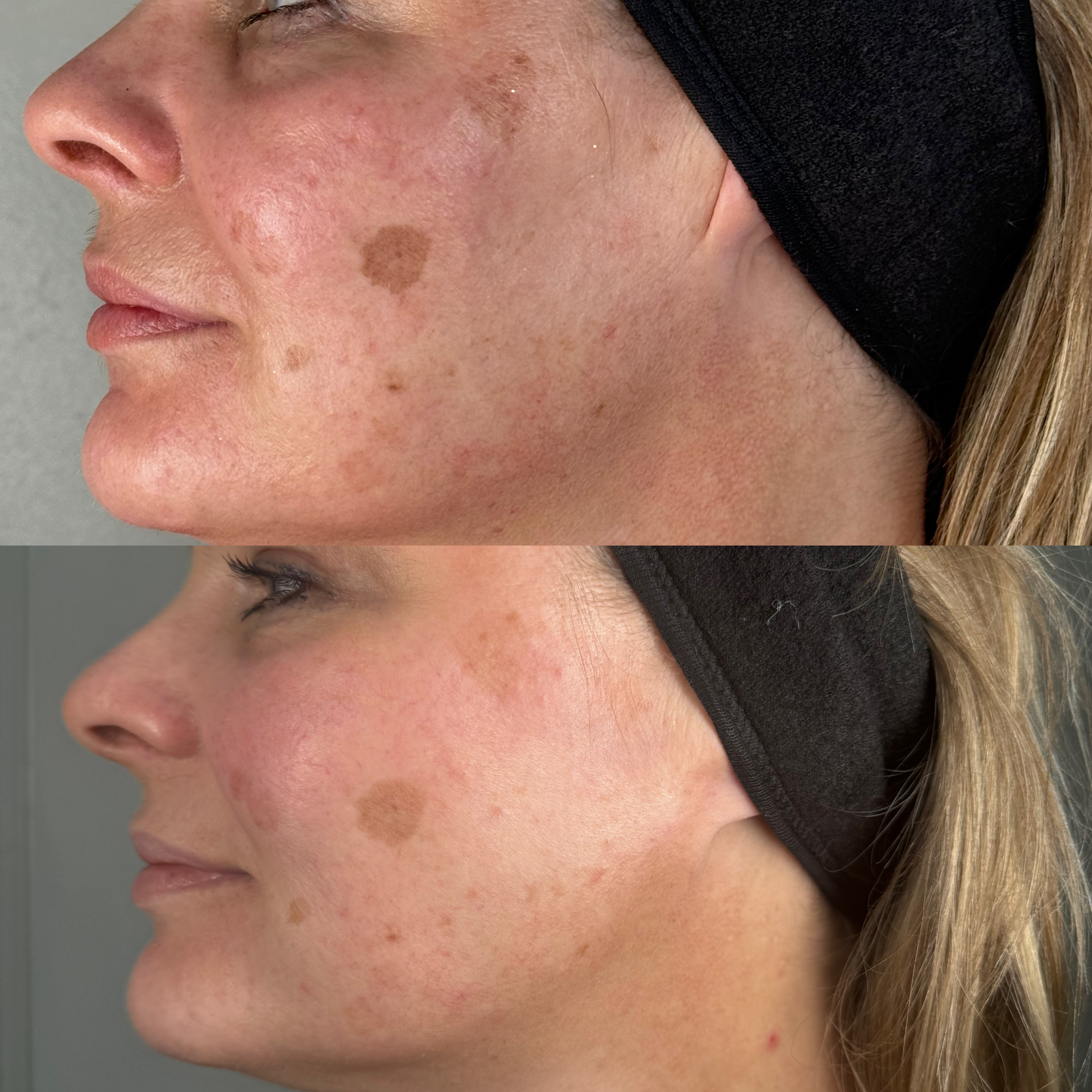 Beyond Skin UK chemical peel before and after — patient two