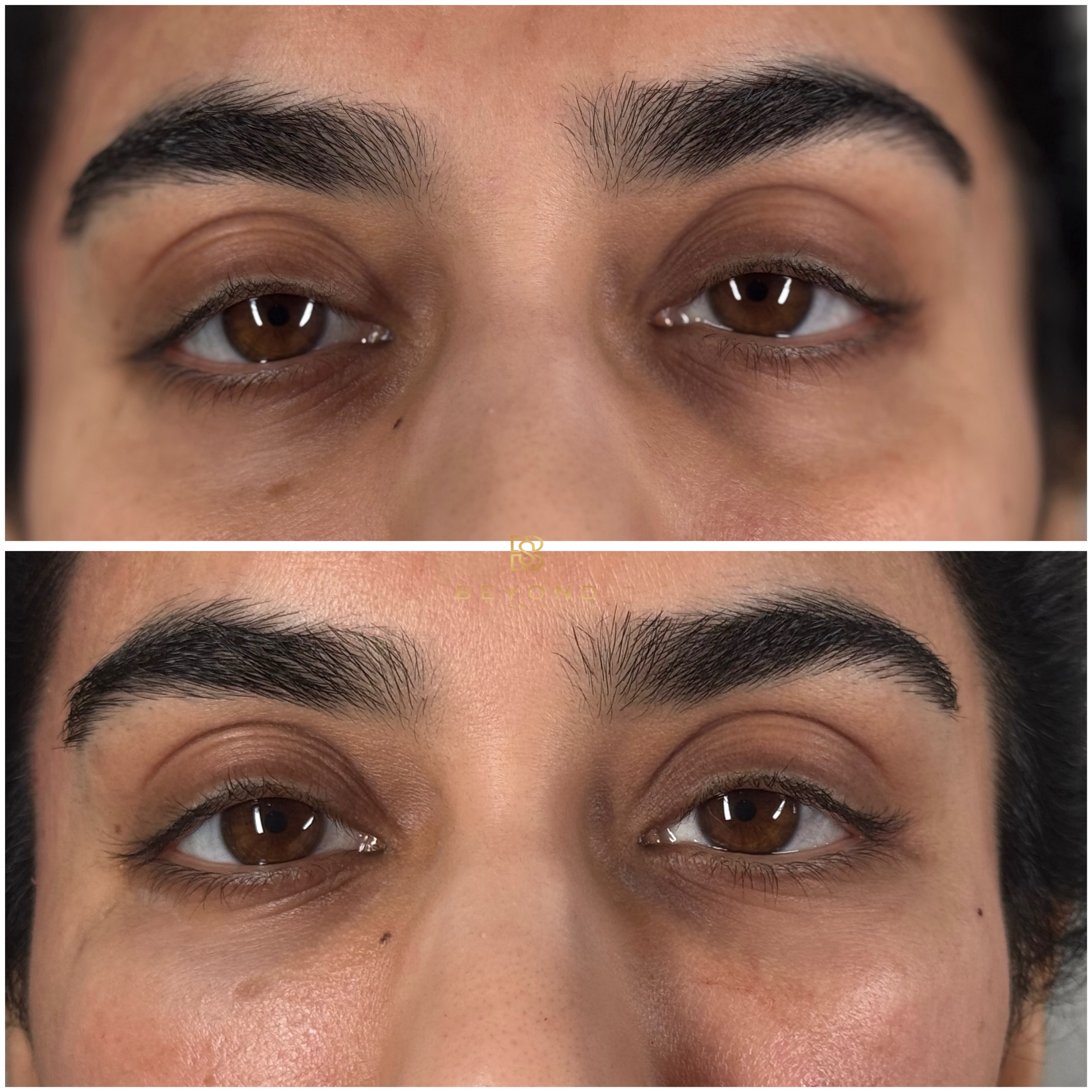 Eye area before (top) and after (bottom) treatment at Beyond Skin UK, second view